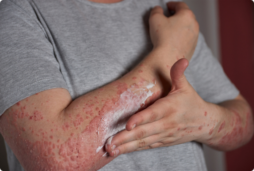 Shingles Treatment