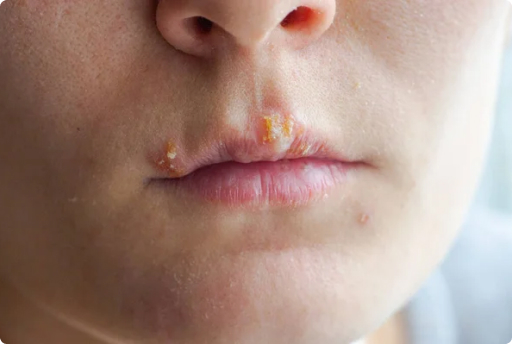 Impetigo